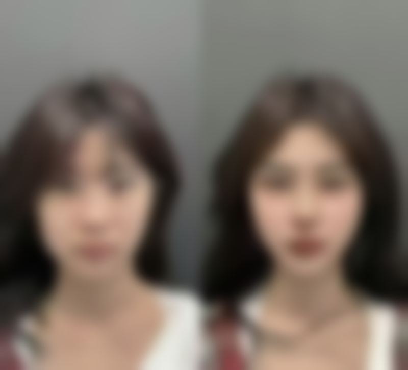 前额植发成效如何