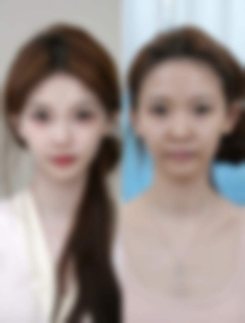 女生前额种植头发贵吗