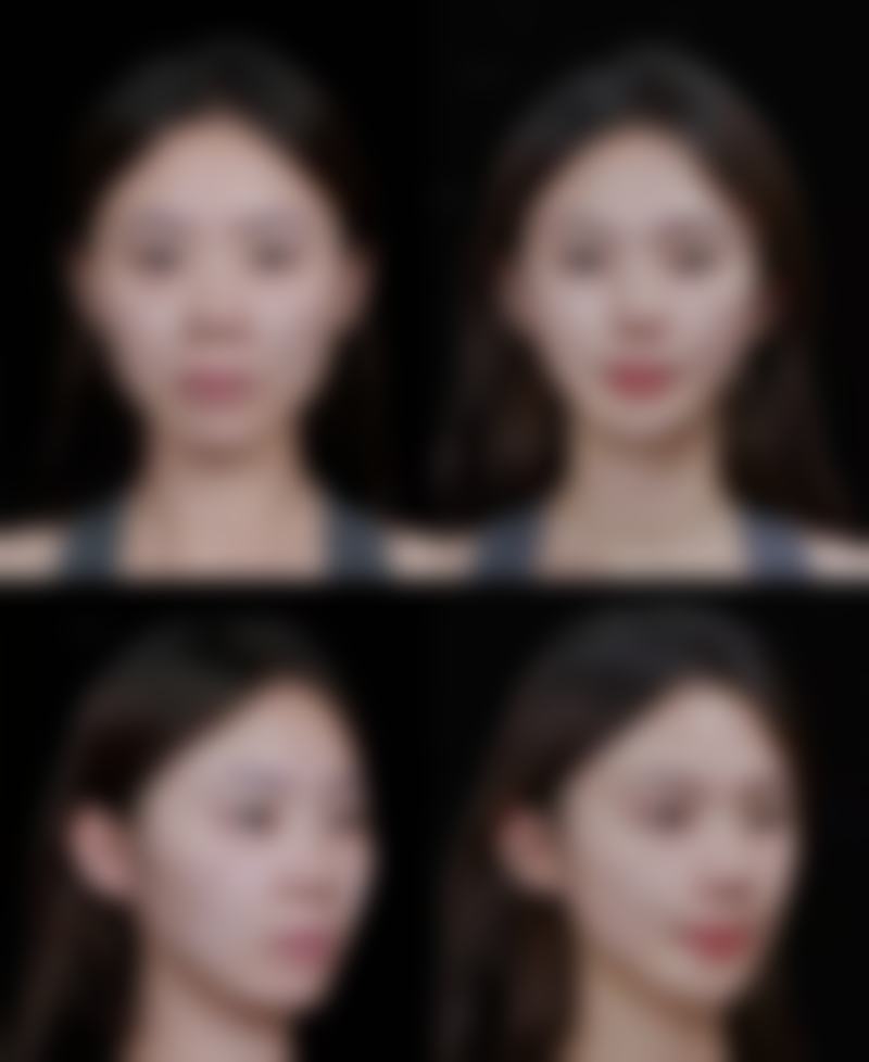 长期打瘦脸针有啥副作用吗