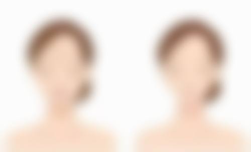 打了瘦脸针可以泡澡嘛