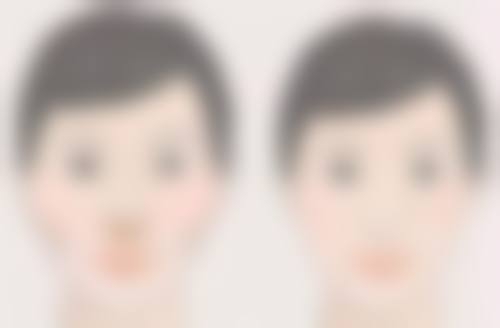 自体脂肪丰臀真实实例