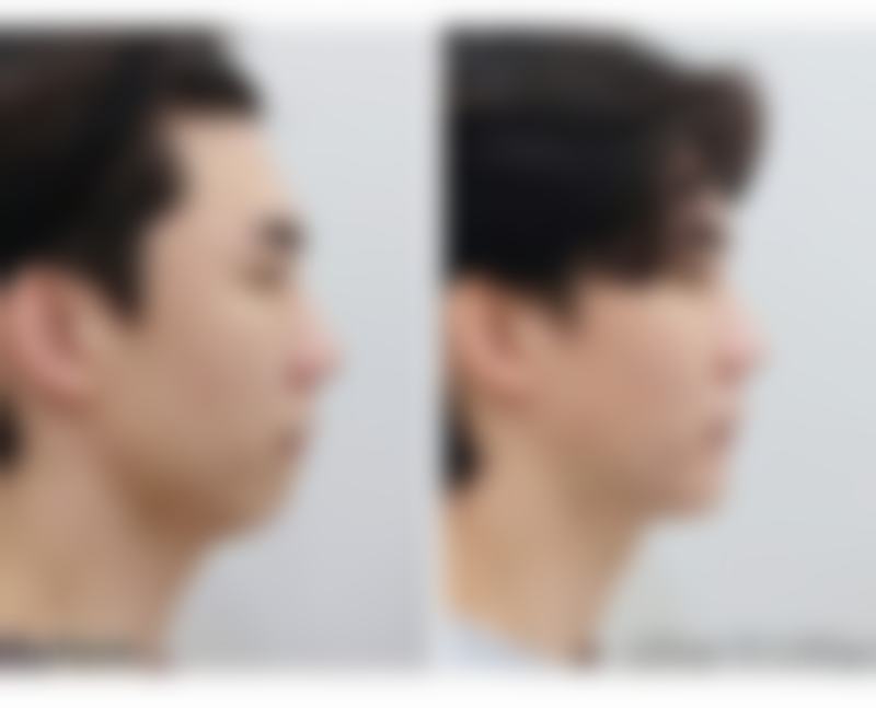 打了瘦脸针会反弹吗