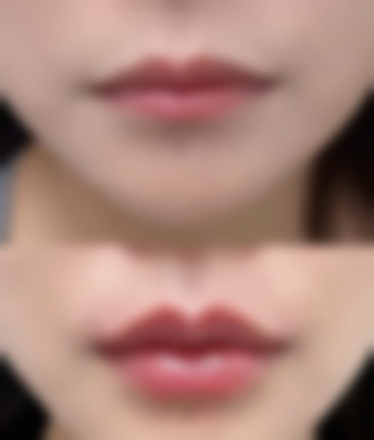 打瘦脸针会垮脸吗