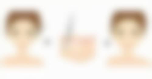 瘦脸针30单位是多少毫升