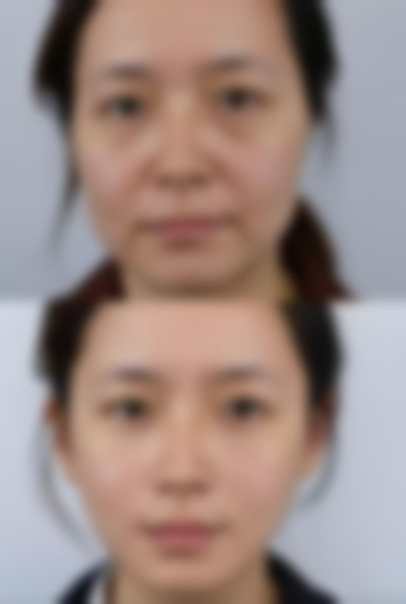 打除皱针的危害