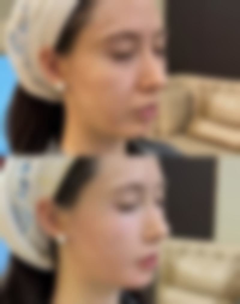 种植头发多久进入脱落期