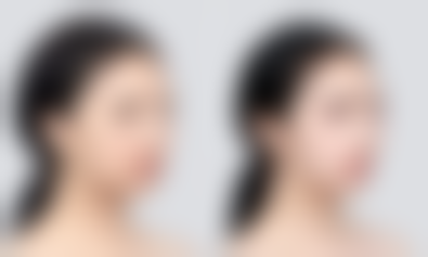 瘦脸针打完多久见效