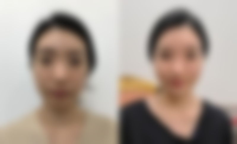 如生天使针——一款新的再生材料