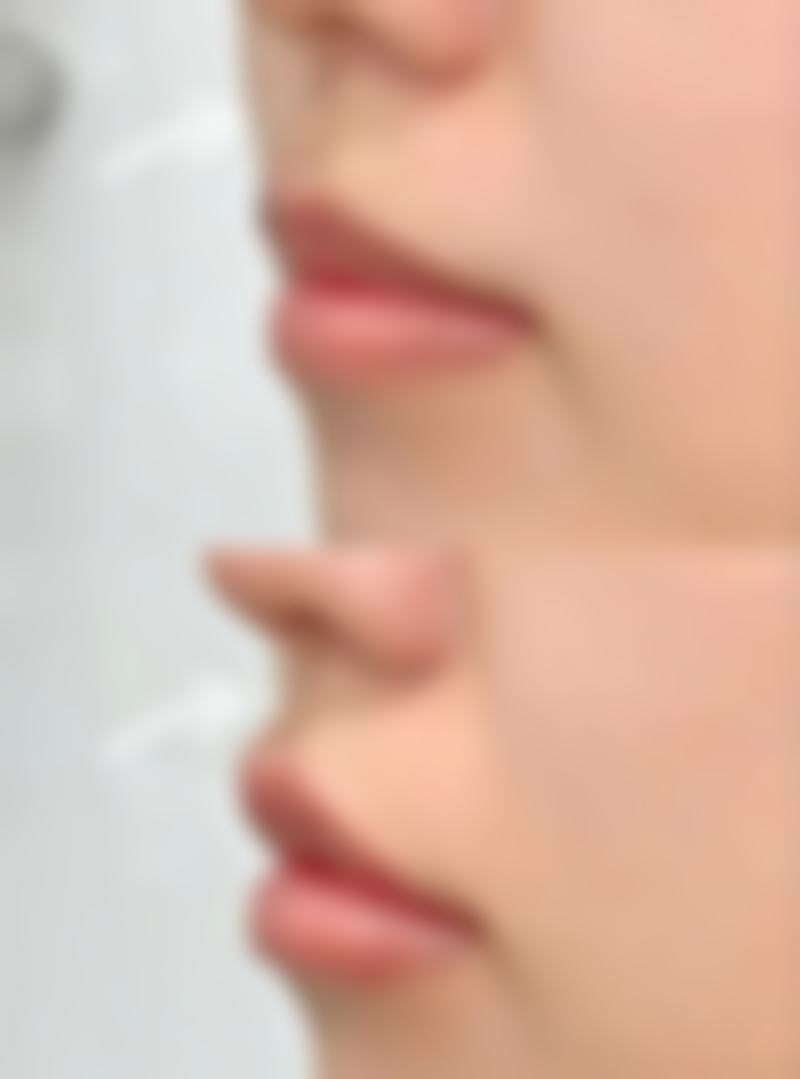 瘦脸针打一次维持多久