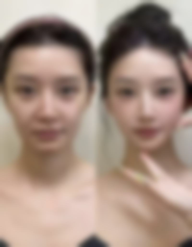 三十多岁打瘦脸针会不会脸部下垂