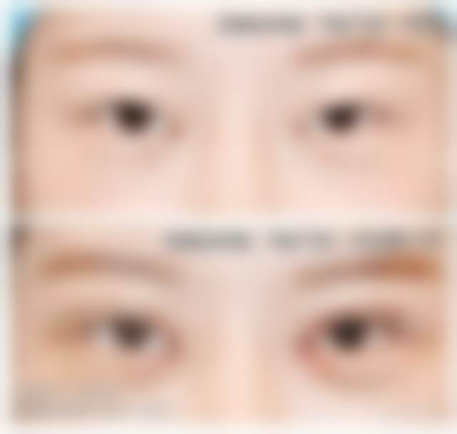 北京客来美舍医美张冰洁医生做去眼袋项目的技术优势