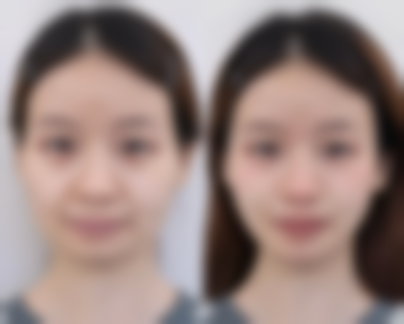 打完瘦脸针六小时后可以平躺吗