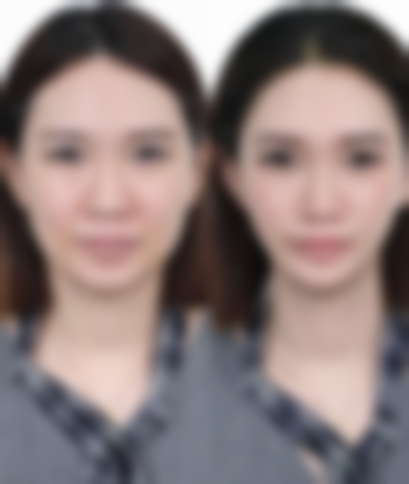 打了瘦脸针六个小时后可以侧卧吗