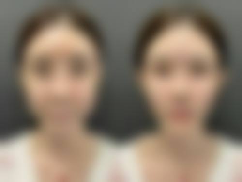 瘦脸针打完多久见效