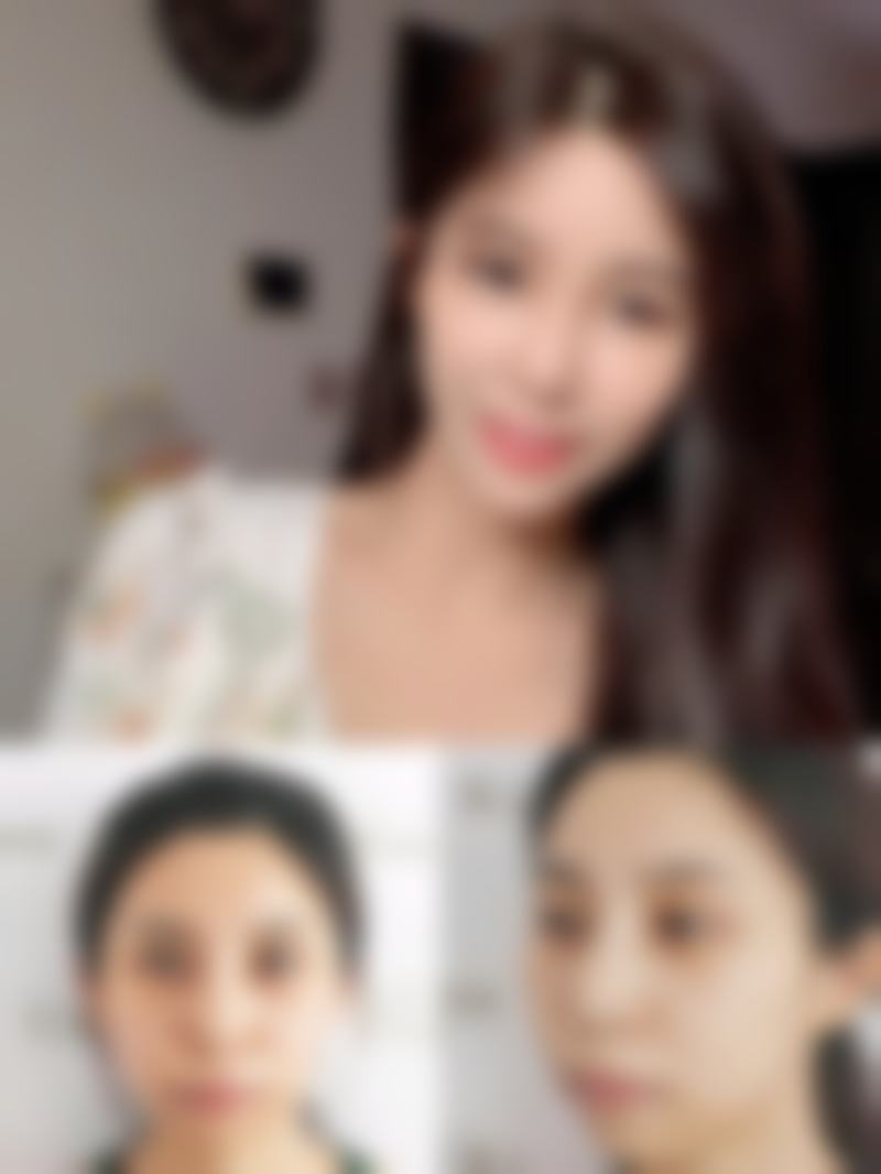 打瘦脸针有后遗症吗