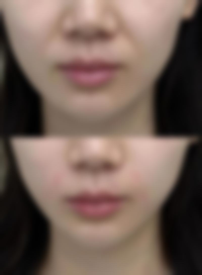 打瘦脸针有什么危害