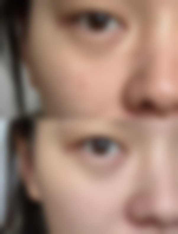 瘦脸针打几次就恒久了