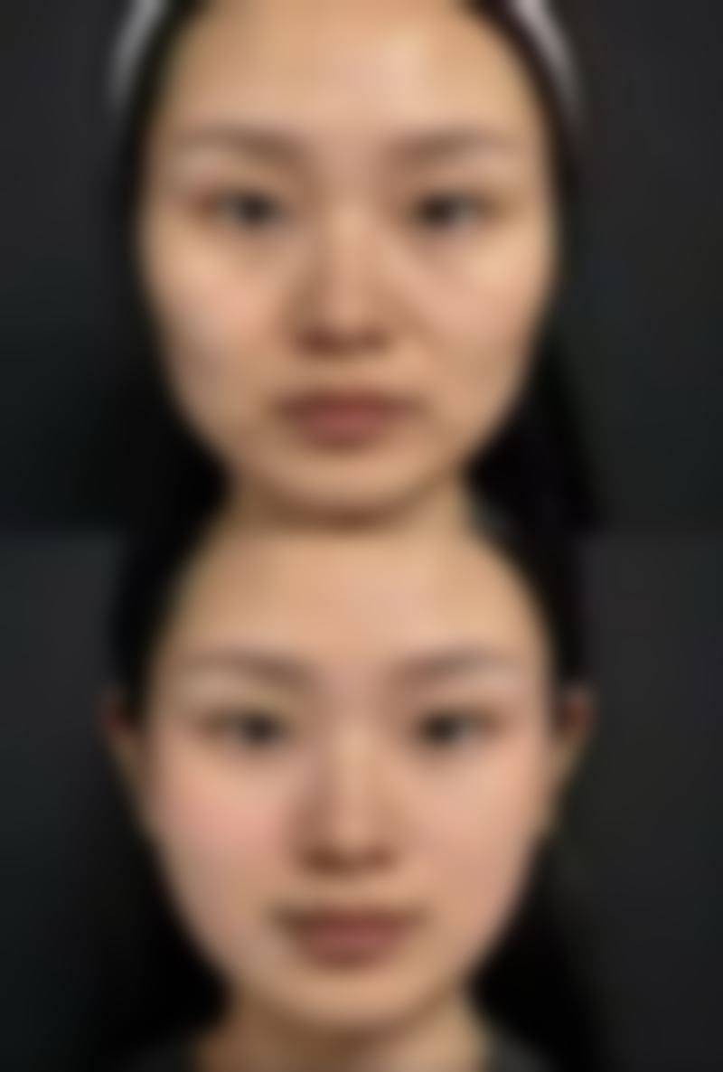 厚唇改薄手术：成效与风险并存