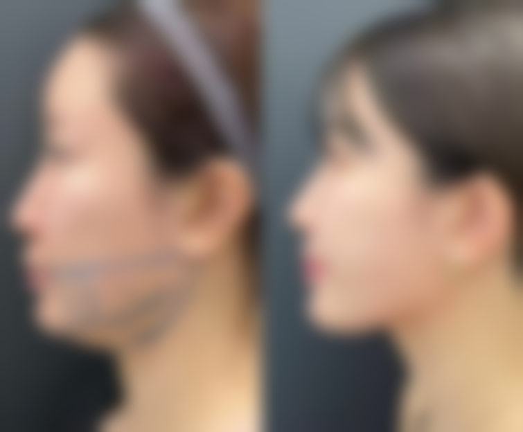 注射瘦脸针瘦脸的成效