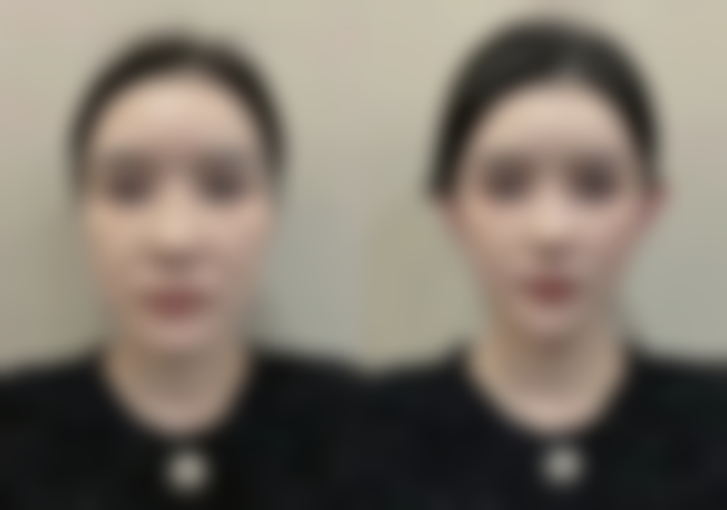 注射瘦脸针的后遗症