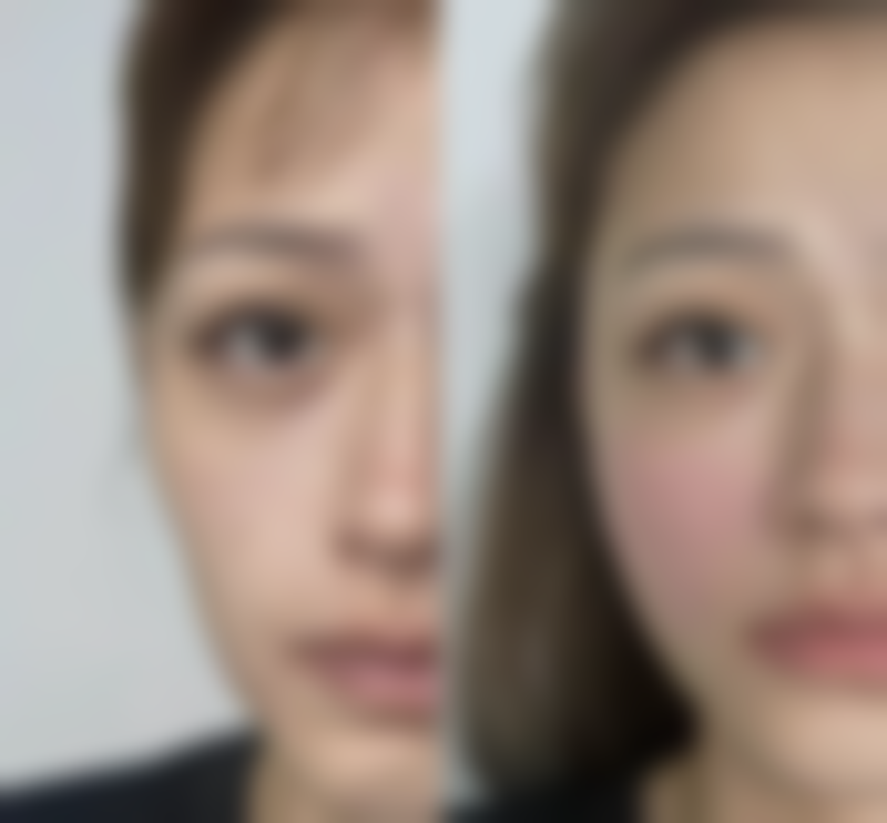 医美手段让薄唇真正变厚