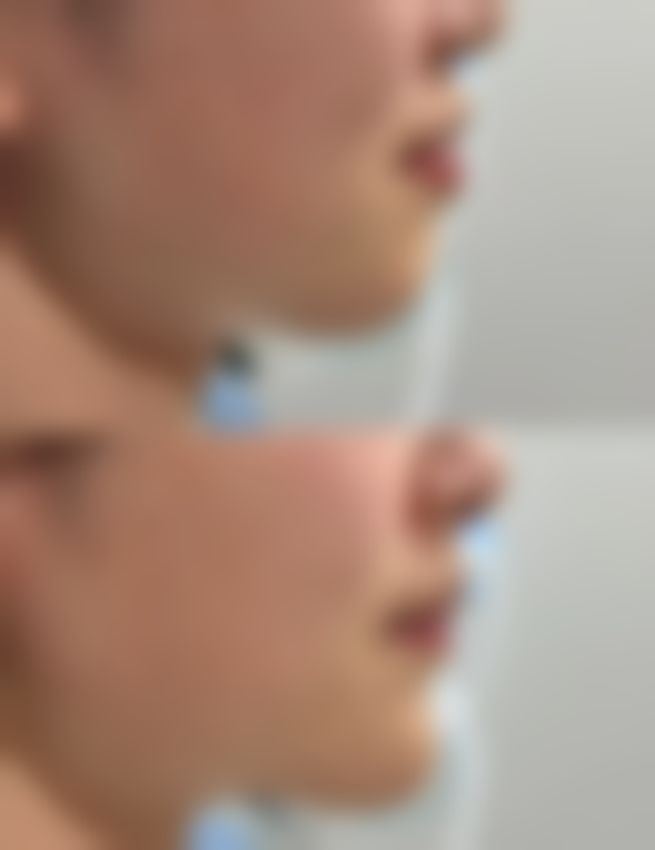 五、打瘦脸针能管多久