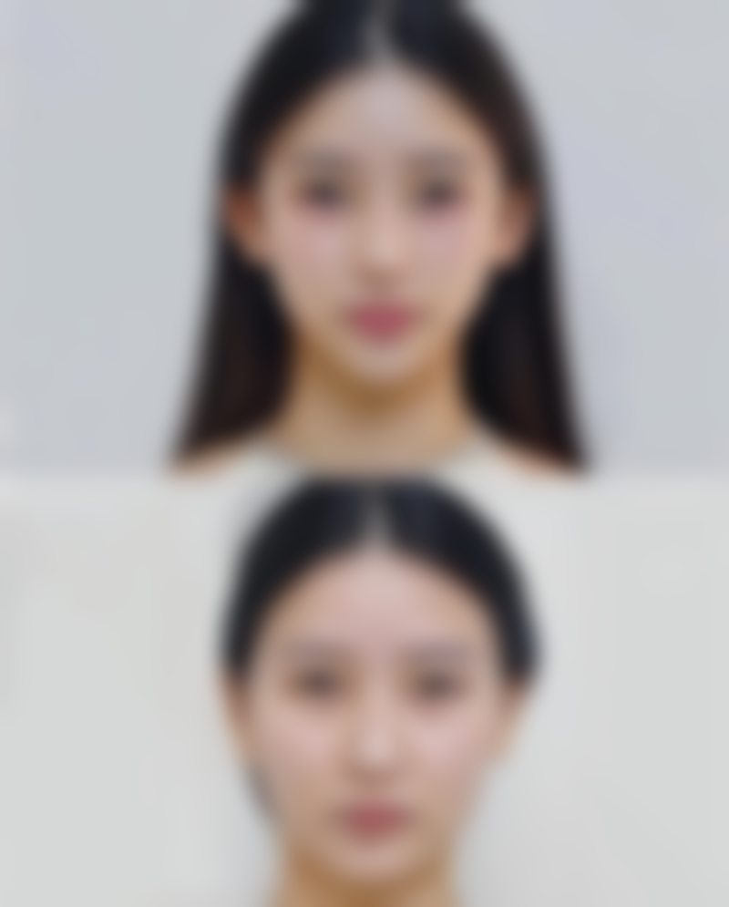 一般下腹、会阴部手术 术后第几天拆线