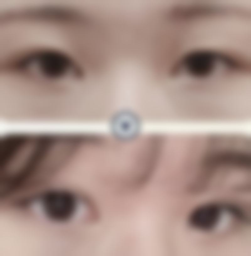 注射瘦脸针对身体有害吗