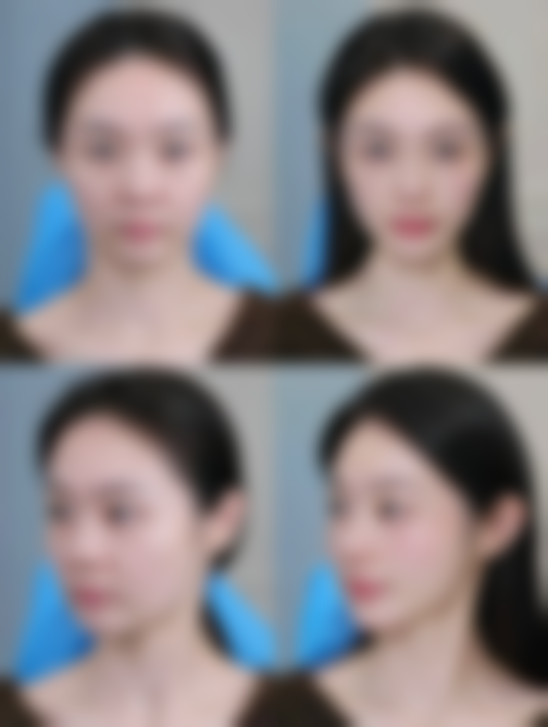 瘦脸针多少钱一次要打几次定型