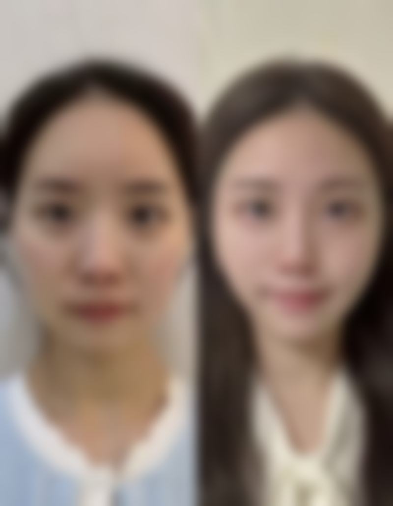 瘦脸针打一次维持多久