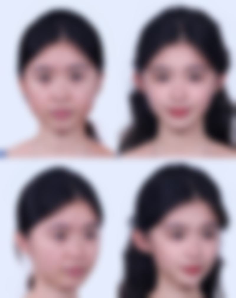 瘦脸针能维持多久