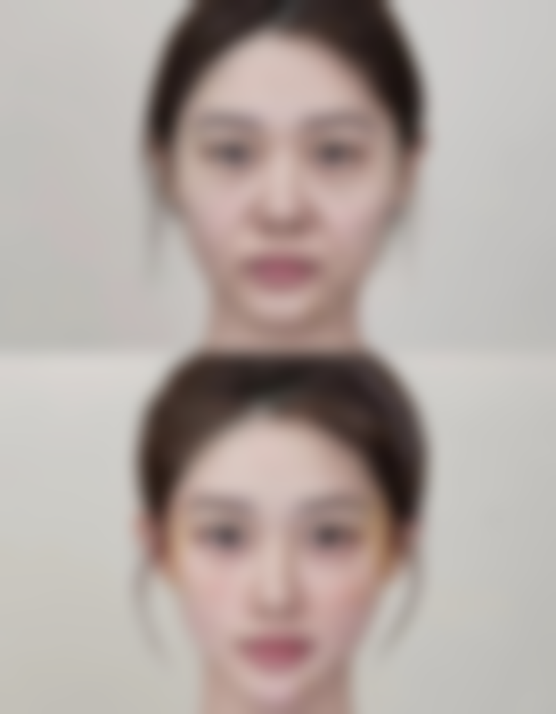 瘦脸针大概多少钱一针