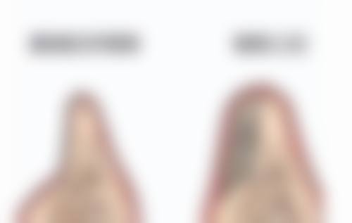 阴道紧缩手术是怎样的手术方式