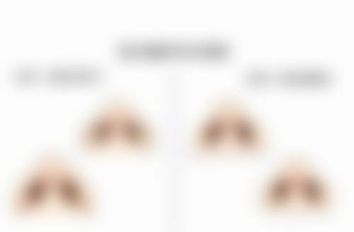 打除皱针打成了肿眼泡怎么办？