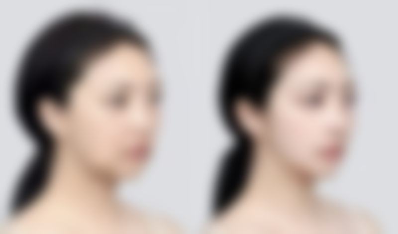 打除皱针的费用是多少？