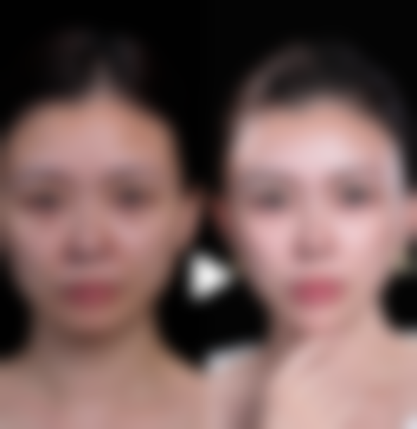 瘦脸针打多少针可以定型