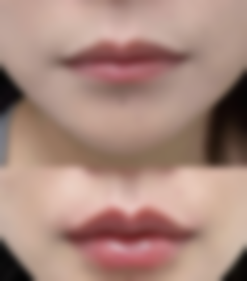 毛发种植一般需要多少钱贵不贵