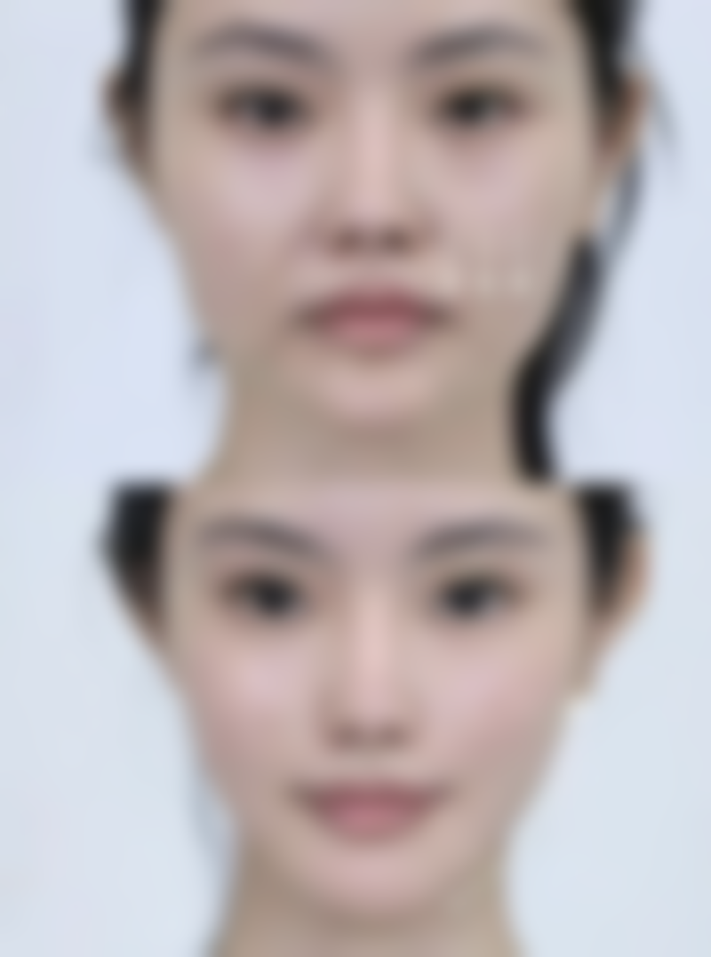 毛发种植一般多少钱