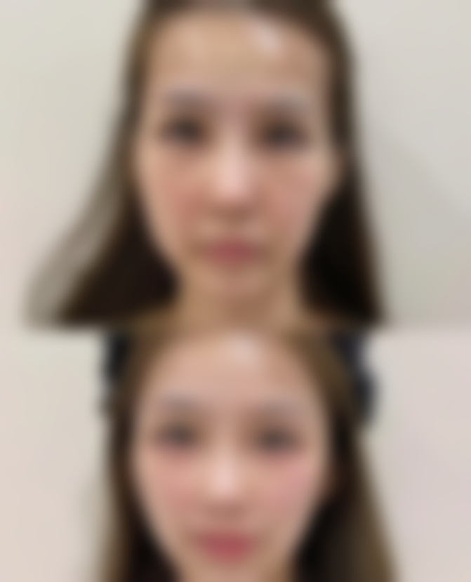 注射瘦脸针管用吗