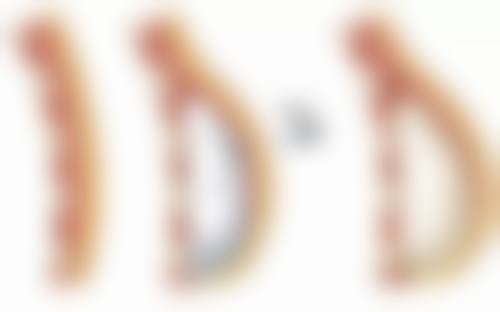 正颌手术可以改变脸型吗