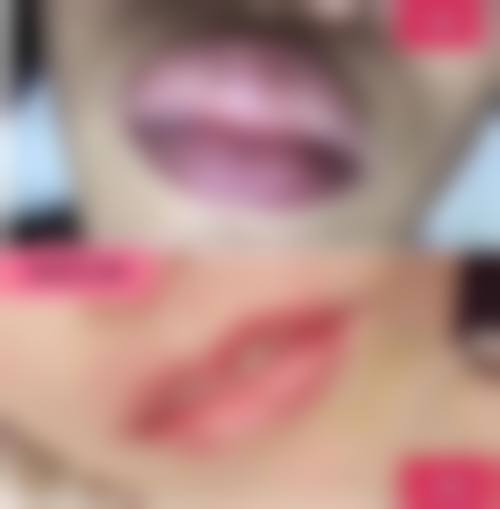 打瘦脸针多少钱一次