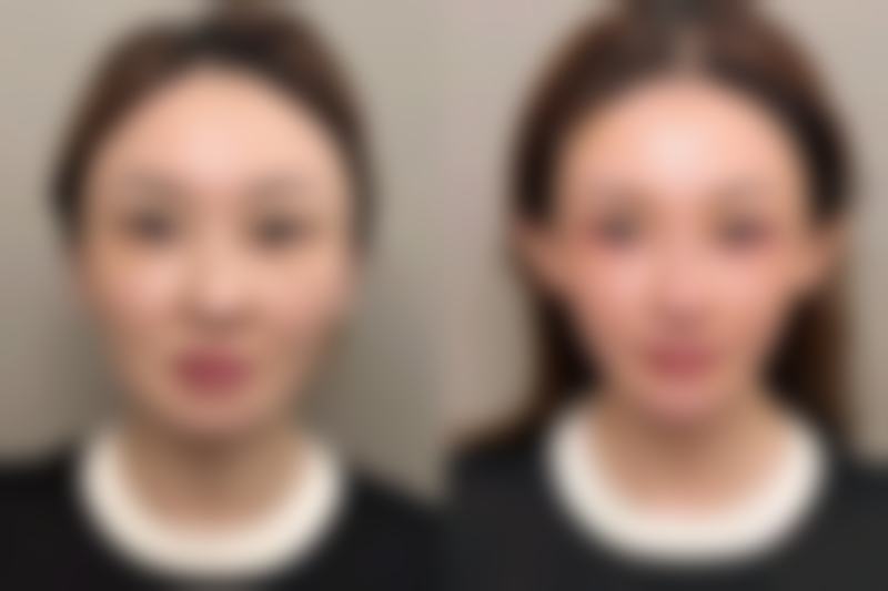 打瘦脸针有后遗症吗