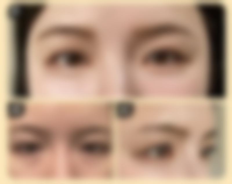 打瘦脸针会垮脸吗