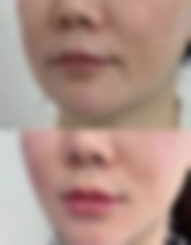 医美除皱的价格及相关项目分析