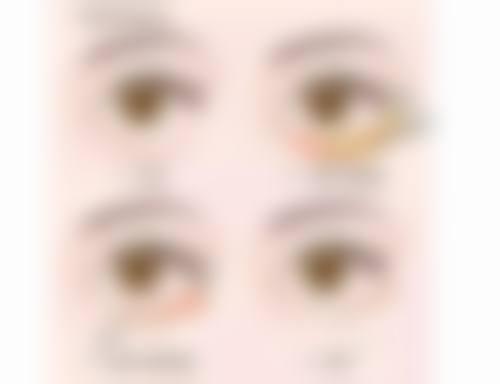 瘦脸针打几次就恒久了