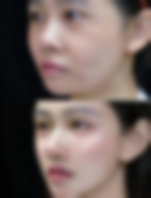 瘦脸针在哪里打