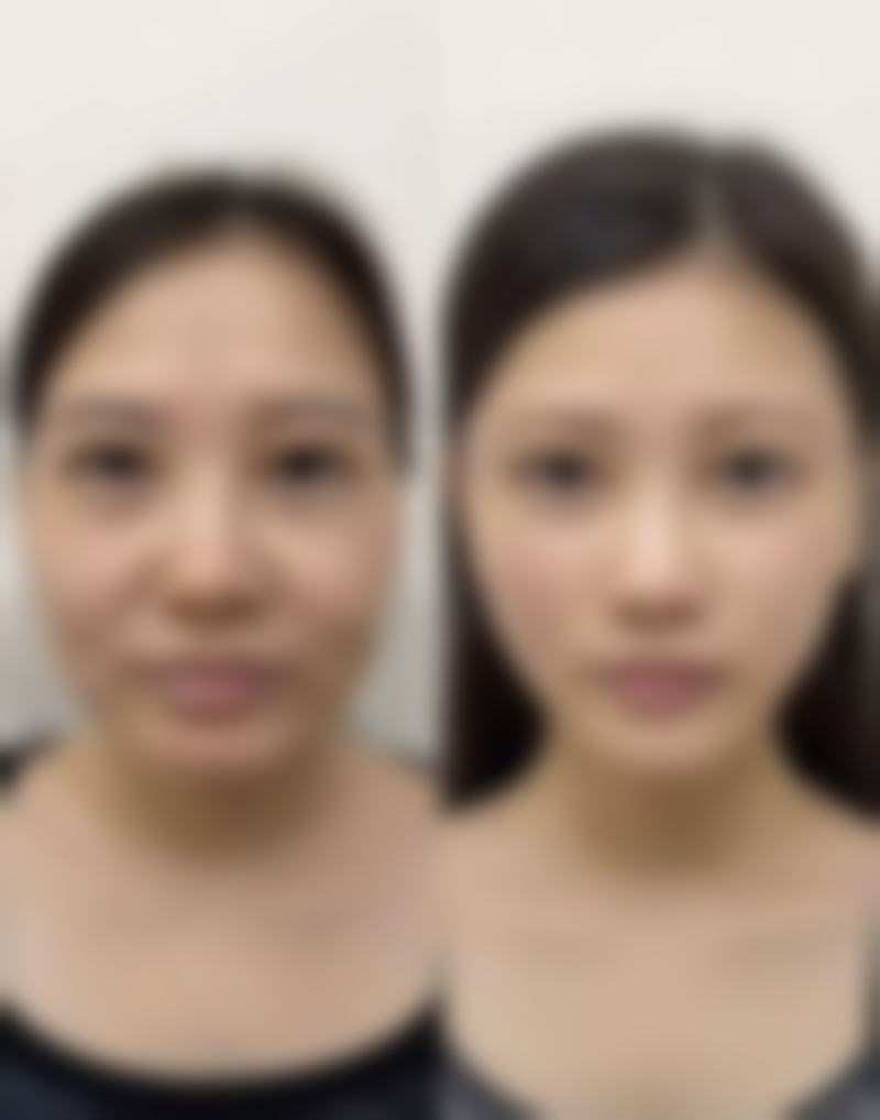 瘦脸针可以打的吗