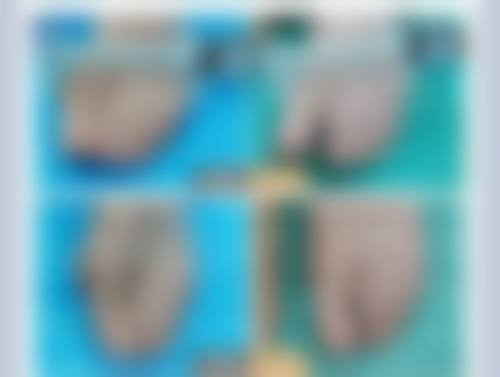 下颌缘加瘦脸针