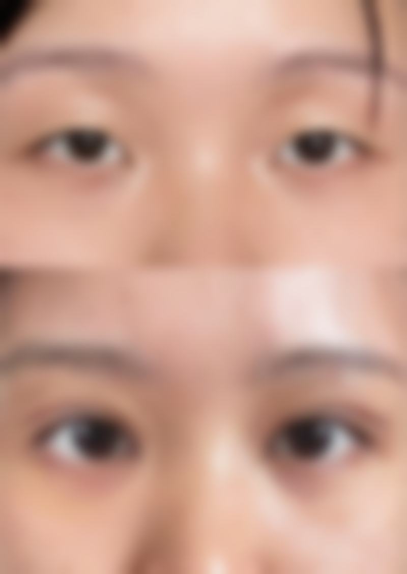 下颌缘与瘦脸针结合成效好吗