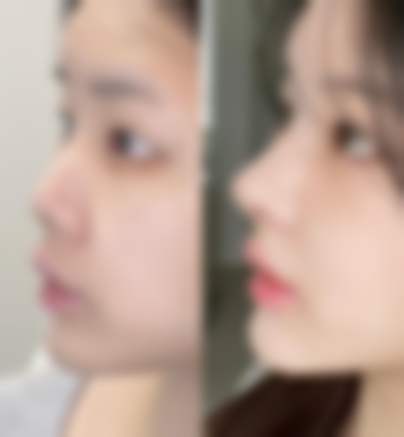 嘴巴往前凸怎么改善自然方法